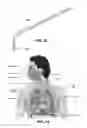 Fig. 30 - Delivery device