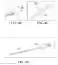 Fig. 03 - Method and apparatus for coupling left ventricle of the heart to the anterior interventricular vein to stimulate collateral development in ischemic regions