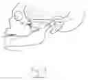 Fig. 03 - Neuromodulatory method for treating chronic or refractory rhinitis