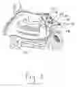 Fig. 04 - Neuromodulatory method for treating chronic or refractory rhinitis