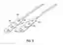 Fig. 04 - Spinal cord stimulation with interferential current