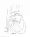 Fig. 05 - Implantable medical device for deployment across the atrioventricular septum