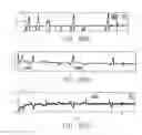Fig. 87 - SENSOR SYSTEMS, DEVICES, AND METHODS FOR CONTINUOUS GLUCOSE MONITORING