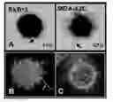 Fig. 01 - Microtentacle imaging in patient tumor samples