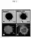 Fig. 02 - Microtentacle imaging in patient tumor samples