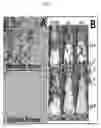 Fig. 03 - Microtentacle imaging in patient tumor samples