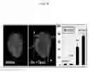 Fig. 05 - Microtentacle imaging in patient tumor samples