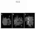 Fig. 07 - Microtentacle imaging in patient tumor samples