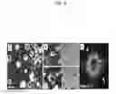 Fig. 10 - Microtentacle imaging in patient tumor samples