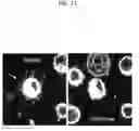 Fig. 12 - Microtentacle imaging in patient tumor samples