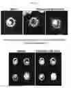 Fig. 16 - Microtentacle imaging in patient tumor samples