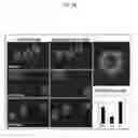 Fig. 25 - Microtentacle imaging in patient tumor samples