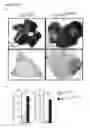Fig. 14 - Personalized therapy of inflammation-associated cancer using methods of assessing the susceptibility of a subject to the treatment with EGFR inhibitors/antagonists