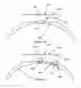 Fig. 04 - Corneal remodelling contact lenses and methods of treating refractive error using corneal remodelling