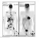 Fig. 01 - Radiotherapy targeted to promote a systemic abscopal effect