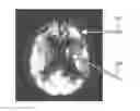 Fig. 01 - Imaging data statistical testing including a stereotactical normalization with a personalized template image