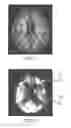 Fig. 02 - Imaging data statistical testing including a stereotactical normalization with a personalized template image