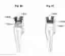 Fig. 69 - Method for patch placement and articles produced
