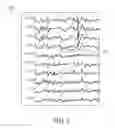 Fig. 06 - Method And System To Calculate qEEG