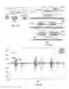 Fig. 06 - System and method of extraction of the heart valve signals