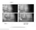 Fig. 05 - DEVICE AND METHOD FOR EXTRACTING FLUIDS FROM TISSUE
