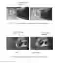 Fig. 07 - DEVICE AND METHOD FOR EXTRACTING FLUIDS FROM TISSUE