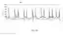 Fig. 06 - Physiological signal processing system and method for filtering noise generated by the same