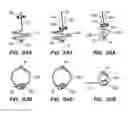 Fig. 118 - SURGICAL CLOSURE CONFIGURATIONS
