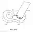Fig. 73 - SURGICAL CLOSURE CONFIGURATIONS