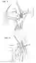 Fig. 04 - Apparatus and method for heart valve repair