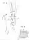 Fig. 05 - Apparatus and method for heart valve repair