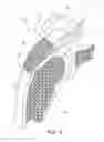 Fig. 07 - Fastener delivery system and related methods
