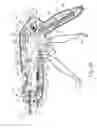 Fig. 06 - Method of applying staples in lower anterior bowel resection