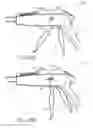 Fig. 35 - Method of applying staples in lower anterior bowel resection