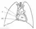 Fig. 01 - System and method for reshaping right heart