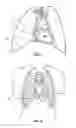 Fig. 02 - System and method for reshaping right heart
