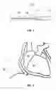 Fig. 03 - System and method for reshaping right heart