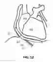 Fig. 07 - System and method for reshaping right heart