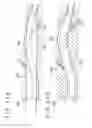 Fig. 17 - MEDICAL DEVICE AND METHOD
