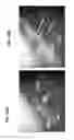 Fig. 50 - Trocar and wound closure device