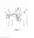 Fig. 02 - Medical device for removing an implanted object