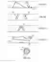 Fig. 08 - Medical device for removing an implanted object