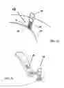 Fig. 04 - Device for fixing a cranial limb to the cranial crown to be placed in the craniotomial hole or cutting, dedicated applying device and process for its use