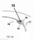 Fig. 07 - Device for fixing a cranial limb to the cranial crown to be placed in the craniotomial hole or cutting, dedicated applying device and process for its use