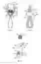 Fig. 11 - BONE FIXING SYSTEM AND METHOD OF USE