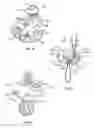 Fig. 14 - BONE FIXING SYSTEM AND METHOD OF USE