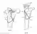 Fig. 15 - BONE FIXING SYSTEM AND METHOD OF USE