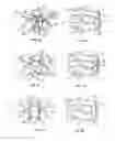 Fig. 17 - BONE FIXING SYSTEM AND METHOD OF USE