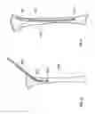 Fig. 12 - FLEXIBLE INTRAMEDULLARY NAIL