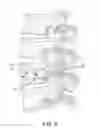 Fig. 06 - Multichannel cannula for kyphoplasty and method of use